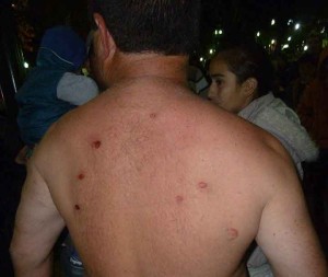 Los rastros de los balazos de goma en la espalda de Jorge López.